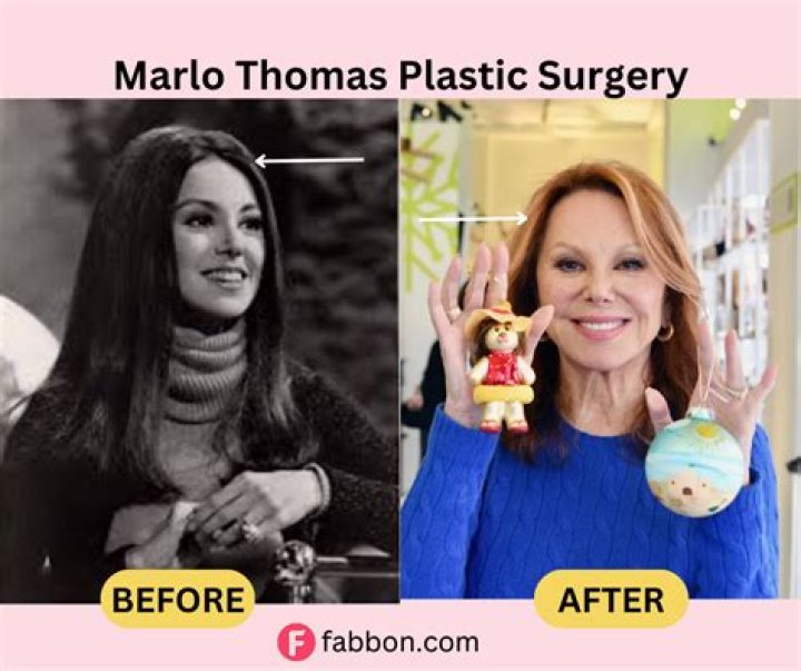 Discover Marlo Thomas' Plastic Surgery Journey: Unlocking Insights And Transformations